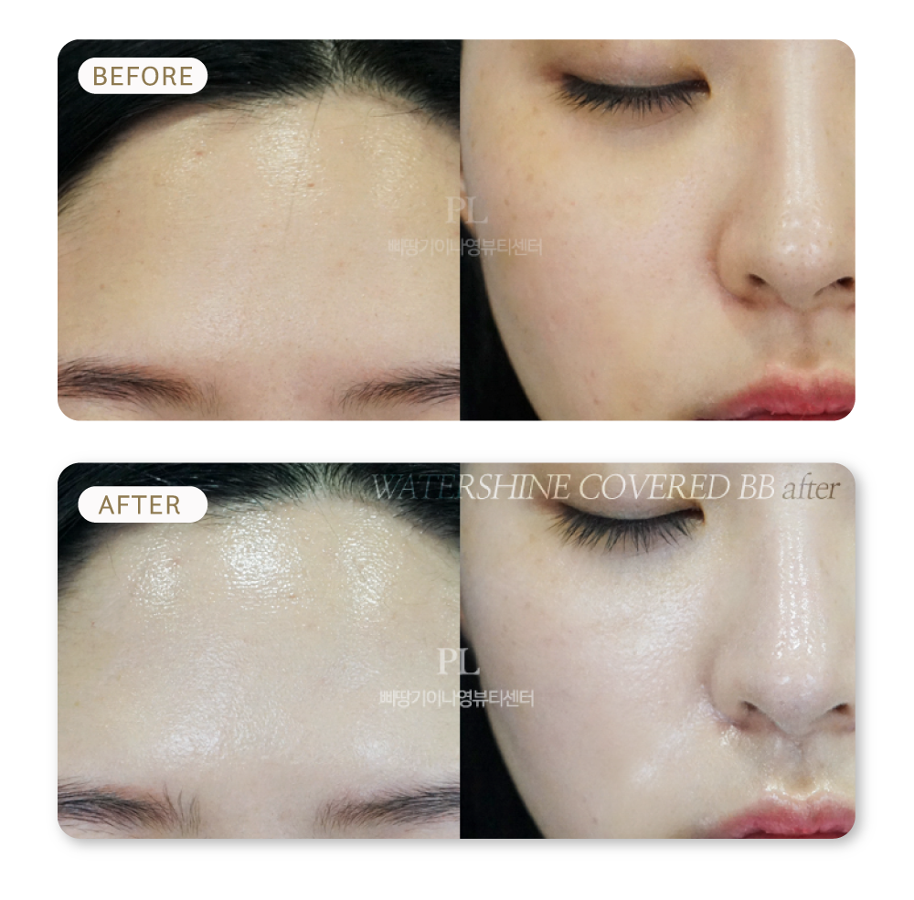 ผลลัพธ์หลังทำ Korean Glow ทรีตเม้นท์หน้าขาวใส